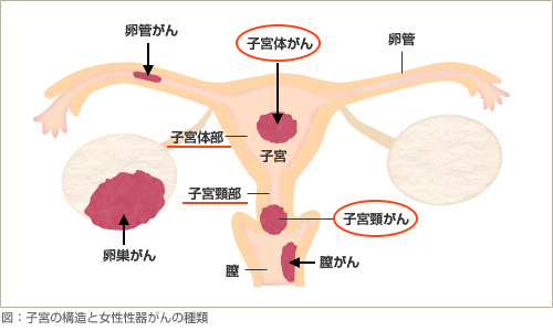 子宮の構造と女性性器がんの種類