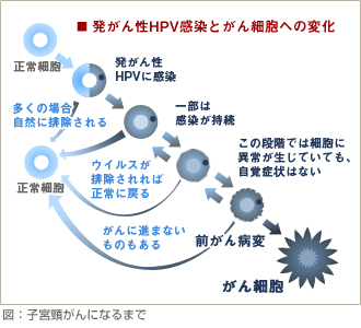 子宮頸がんになるまで
